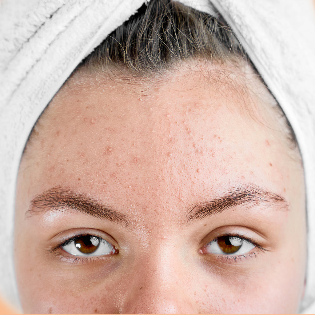 Female with hair wrapped in towel showing forehead with acne problem